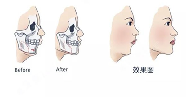 正颌矫正凸嘴