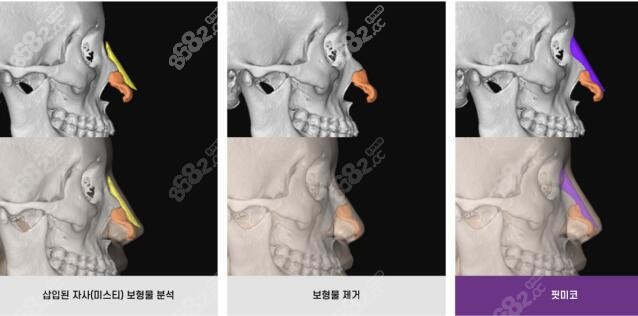 歌柔飞3D打印隆鼻手术方案设计