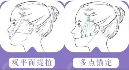 谭永嘉医生的“微拉美全脸提升术”