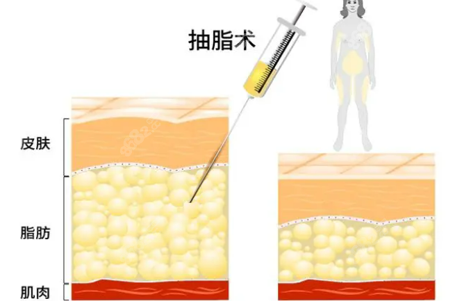 深圳富华李俊医生吸脂