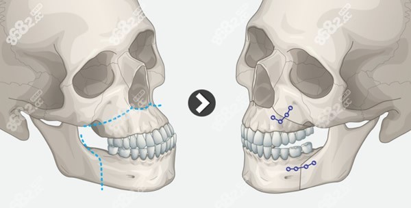 正颌手术原理前后对比图