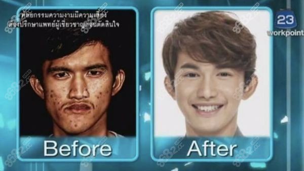 泰国面部轮廓整容医院男士磨骨手术对比图.jpg