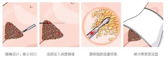 运城做腰腹吸脂的原理