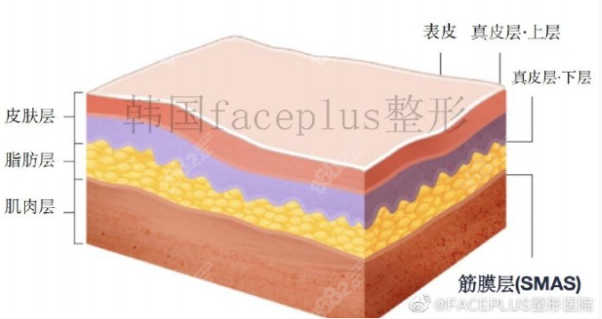 韩国FACEPLUS面部提升手术