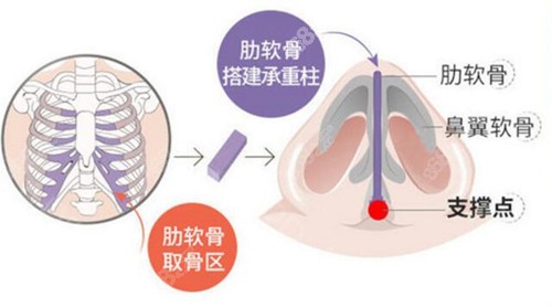 韩国ID医院鼻修复技术图