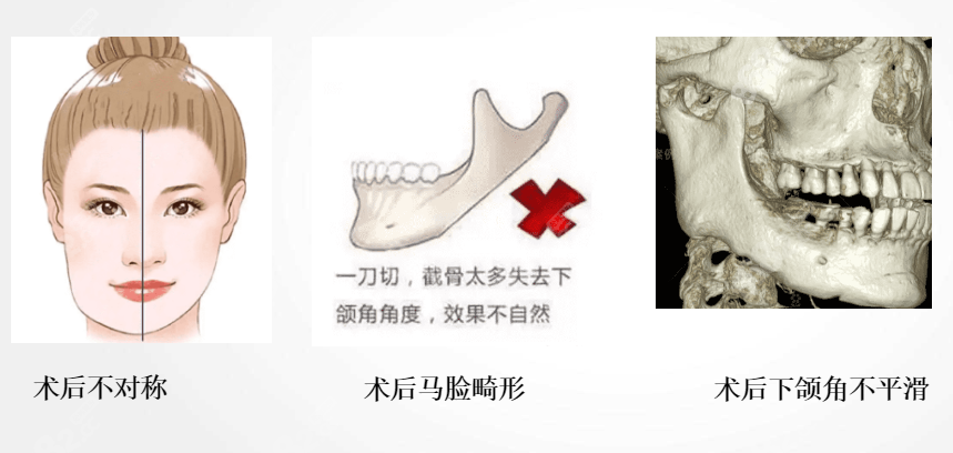 韩国欧佩拉医院做轮廓怎么样