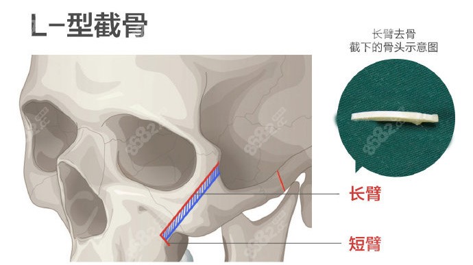 重庆松山医院颧骨整形技术先进m.8682.cc