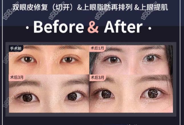 韩国ts医院眼修复图片