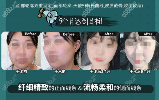 韩国ts医院面部轮廓整形前后对比照片