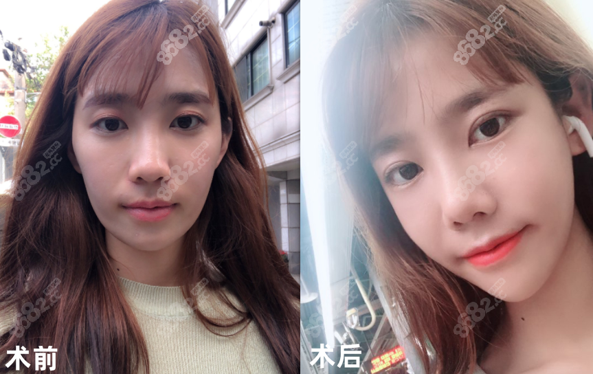 欧佩拉医院轮廓修复真实照片www.8682.cc