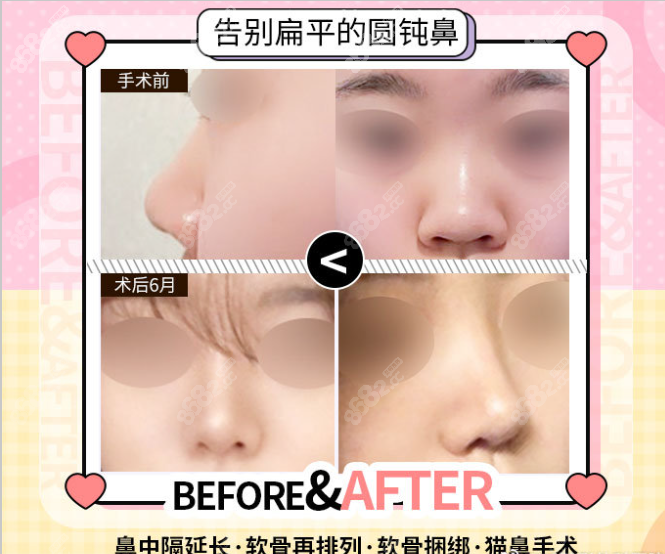 韩国ts医院鼻综合隆鼻前后对比图片