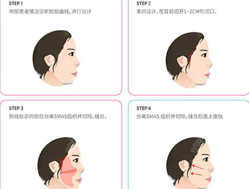 韩国迪美整形面部提升