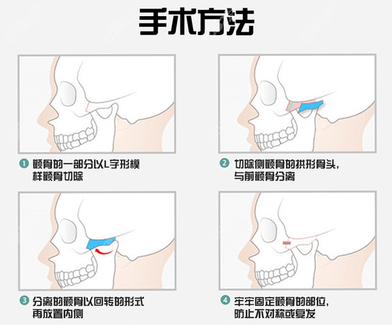 韓國ts做顴骨手術(shù)的方法