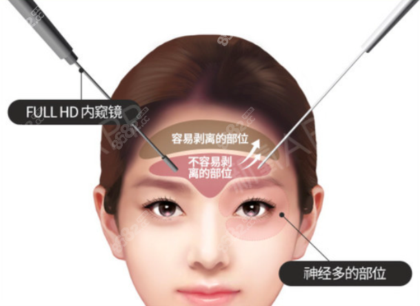 韩国优雅人内窥镜额头提升手术图示