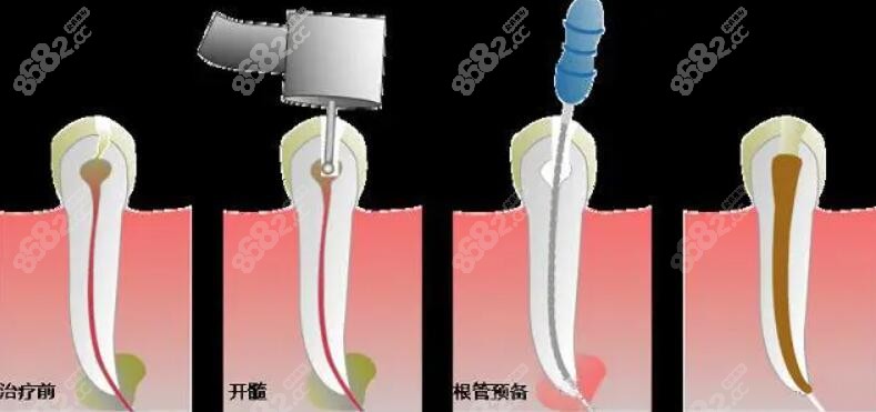 初次根管治疗流程