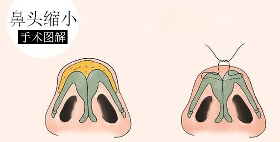 鼻头缩小手术前后图www.8682.cc
