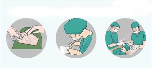 植發(fā)流程 植發(fā)流程