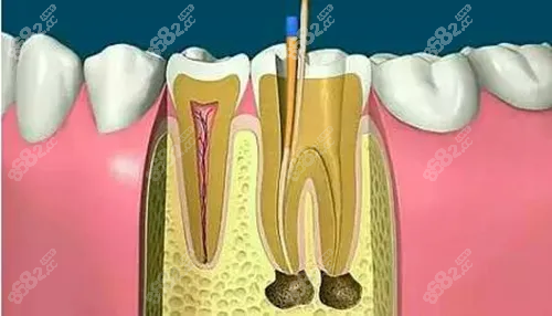 佛山口腔医院根管治疗费用:含前牙/后牙/二次根管收费标准,牙齿修复
