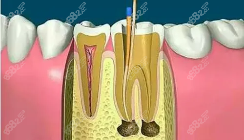佛山口腔医院根管治疗费用:含前牙/后牙/二次根管