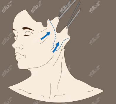 迷你小切口筋膜提升和埋线提升区别之一在于手术原理（m.8682.cc）