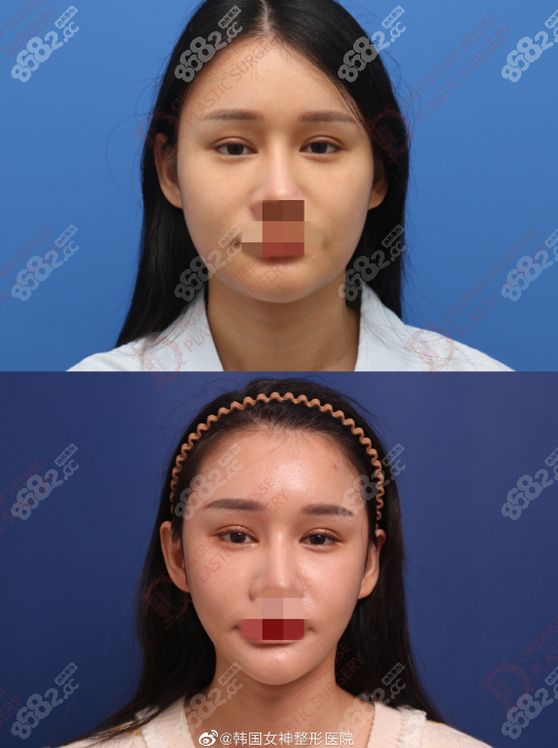 轮廓手术正面对比照片