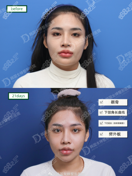 韩国女神磨骨手术实例图8682.cc