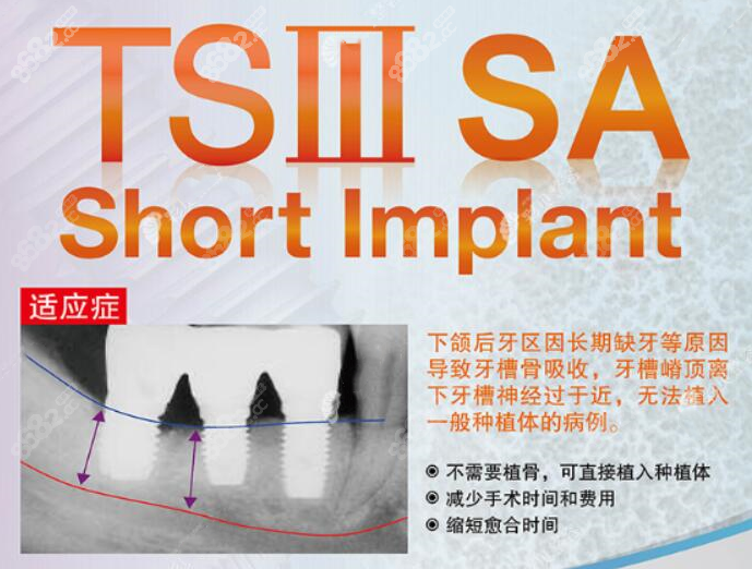 奥齿泰ts3 SA植体的优势8682.cc