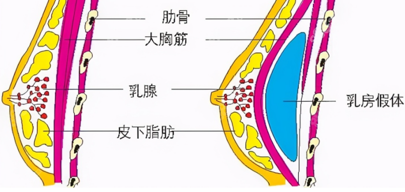 阳光医院陈星光医生做胸部如何？