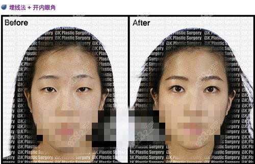 韩国BK双眼皮手术前后对比图