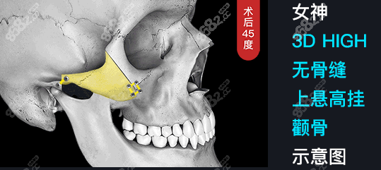 韩国女神颧骨手术