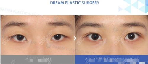 韩国梦想双眼皮手术真人实例