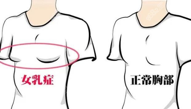 韩国做男性女乳症治疗哪家医院好