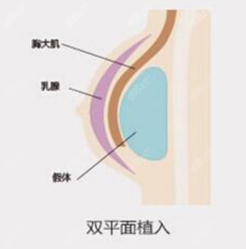 罗志敏医生隆胸