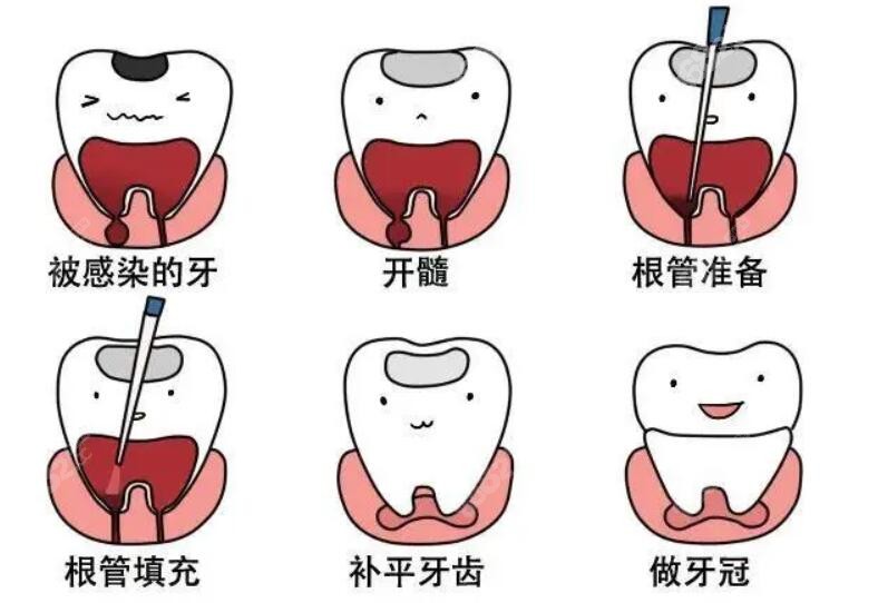 二次根管治疗流程