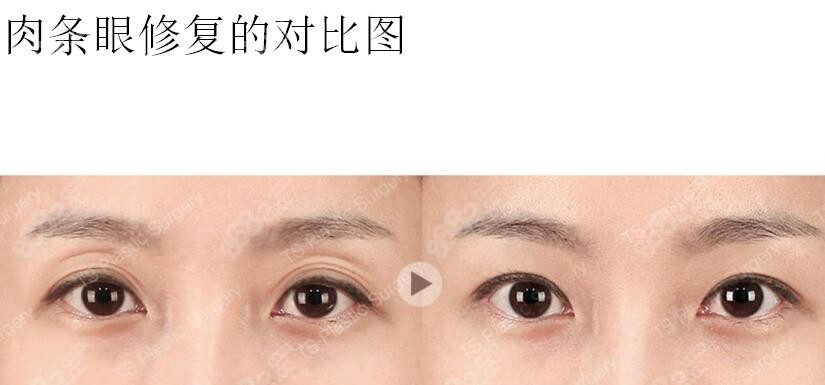 ts整形做肉條眼修復(fù)的對比圖m.66ub.cn ts整形做肉條眼修復(fù)的對比圖m.66ub.cn