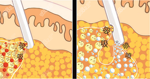 西安吸脂医生哪个比较好