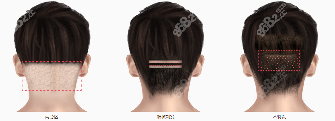 韩国非切开式植发优缺点