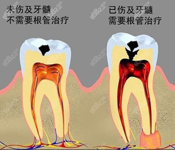 根管治疗