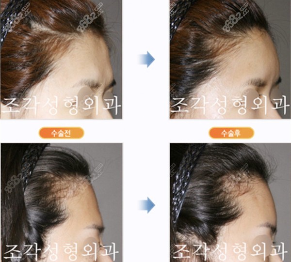 雕刻整形外科醫(yī)院額頭填充對比