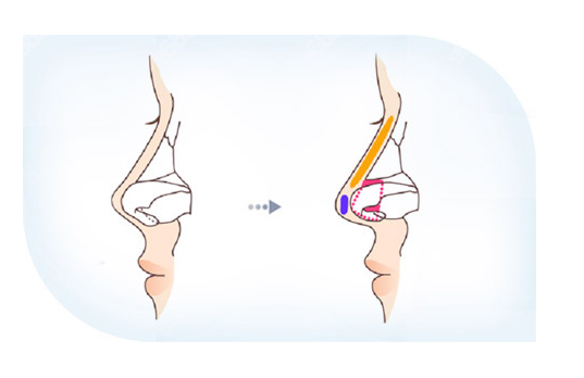 鼻小柱延长术用什么材料好