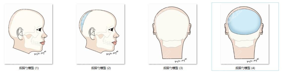 韓國(guó)雕刻骨水泥填充后腦勺價(jià)格不貴