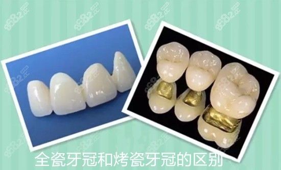 全瓷牙冠和烤瓷牙冠哪个好？