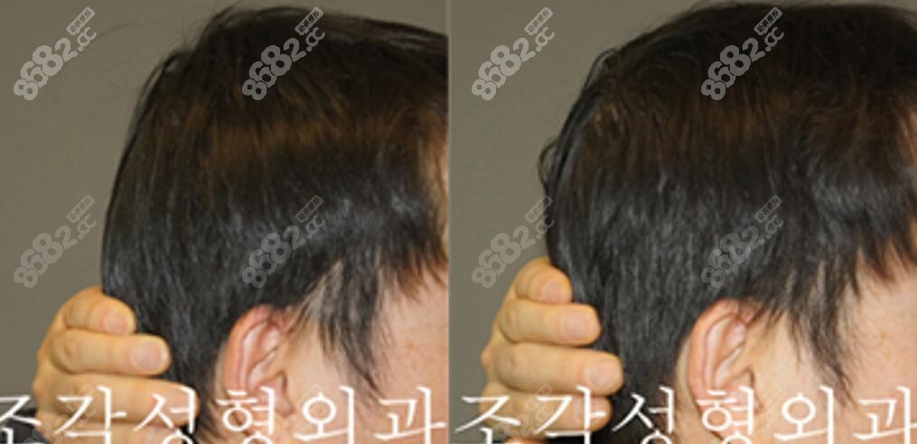 韓國(guó)雕刻醫(yī)院骨水泥填充后腦勺會(huì)不會(huì)凹凸不平