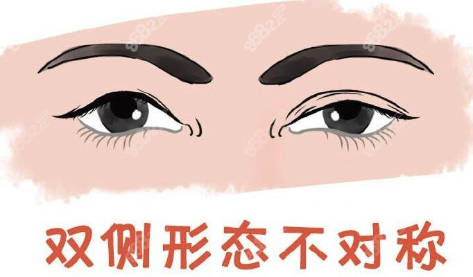 西安哪里做双眼皮修复做得好