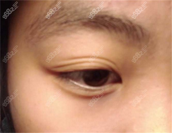 雙眼皮好幾層怎么解決？