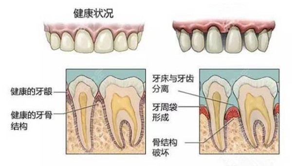 根据我们的牙槽骨情况来选择种植牙