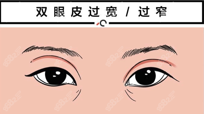 西安双眼皮修复医院推荐名单www.8682.cc