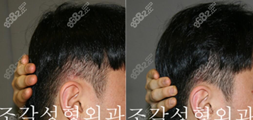 韓國(guó)雕刻醫(yī)院骨水泥填充后腦勺對(duì)比圖
