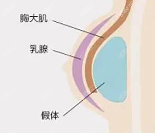 隆胸结构图