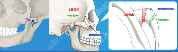 西安改臉型醫(yī)院在哪里www.ekelt.cn
